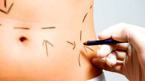 Ilustrativa - Segundo médico, toda cirurgia apresenta riscos e é preciso compreender os motivos que levam a paciente a querer a modificação corporal Ilustrativa - Segundo médico, toda cirurgia apresenta riscos e é preciso compreender os motivos que levam a paciente a querer a modificação corporal
