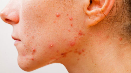 Ilustrativa - Número de casos de mulheres adultas com acne cresceu no Brasil Ilustrativa - Número de casos de mulheres adultas com acne cresceu no Brasil
