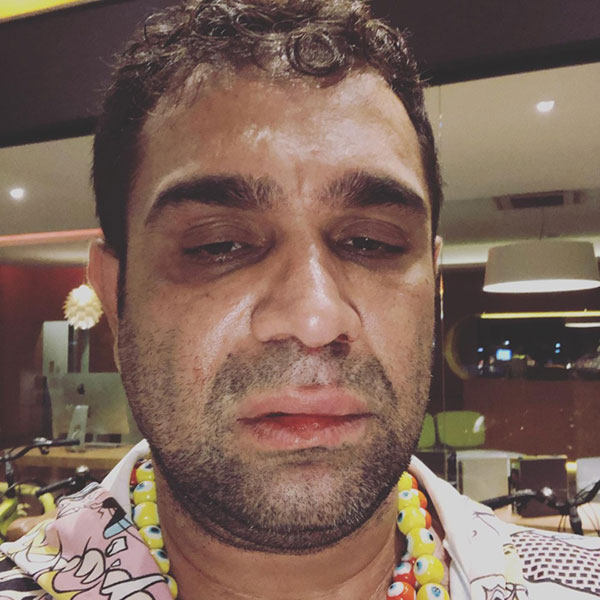 redes sociais - O humorista Evandro Santo postou foto com os ferimentos que sofreu