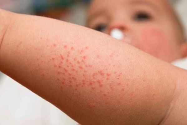 Ilustrativa - Alergia atópica é mais comum na infância e cerca de 60% dos casos ocorrem no primeiro ano de vida