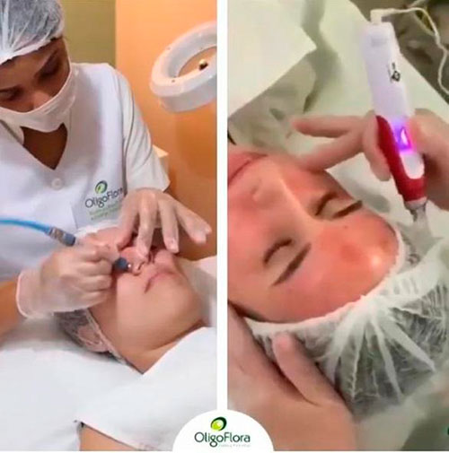 Divulgação - Microagulhamento estimula a produção de colágeno Divulgação - Microagulhamento estimula a produção de colágeno