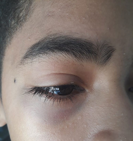 divulgação - O aluno ficou com um hematoma no olho direito divulgação - O aluno ficou com um hematoma no olho direito