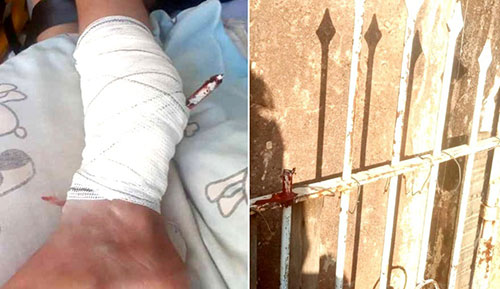 I7 Notícias - Criança cai em portão e fica com lança de ferro cravada na perna em Paraguaçu Paulista — Foto: Manoel Moreno/i7 Notícias