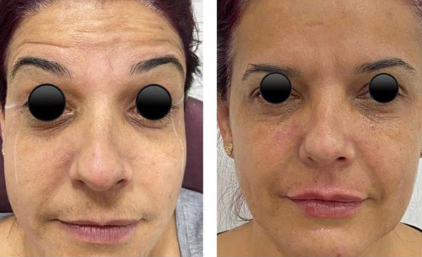 Antes e depois de botox, preenchimento com ácido hialurônico de olheiras e contorno superior do lábio Antes e depois de botox, preenchimento com ácido hialurônico de olheiras e contorno superior do lábio