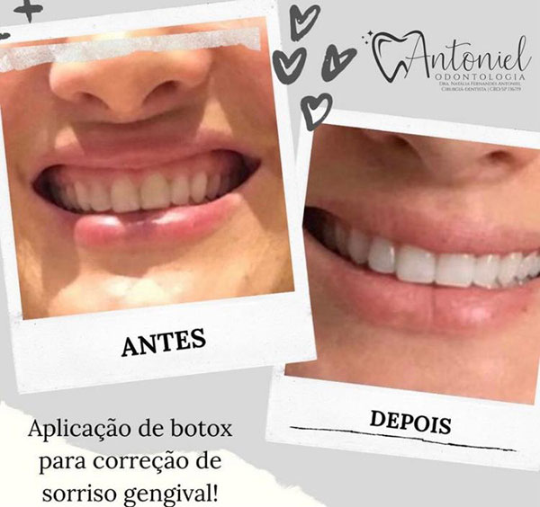 Aplicação de botox para correção de sorriso gengival Aplicação de botox para correção de sorriso gengival