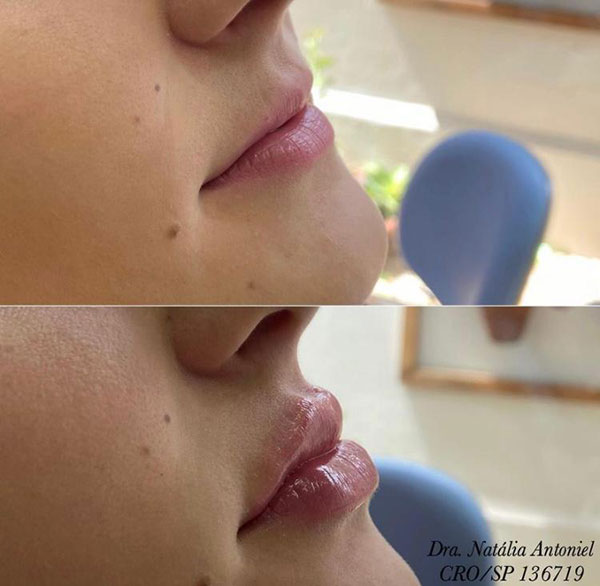 Antes e depois preenchimento labial