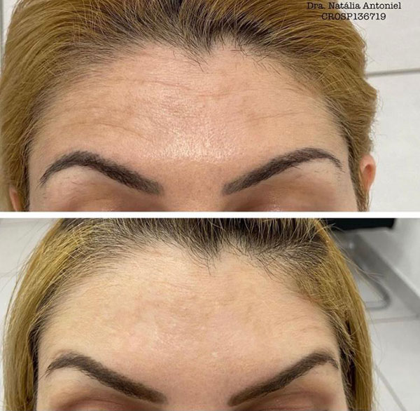 O botox funciona paralisando os músculos, para eliminar as ruguinhas que se formam quando nós fazemos algumas expressões