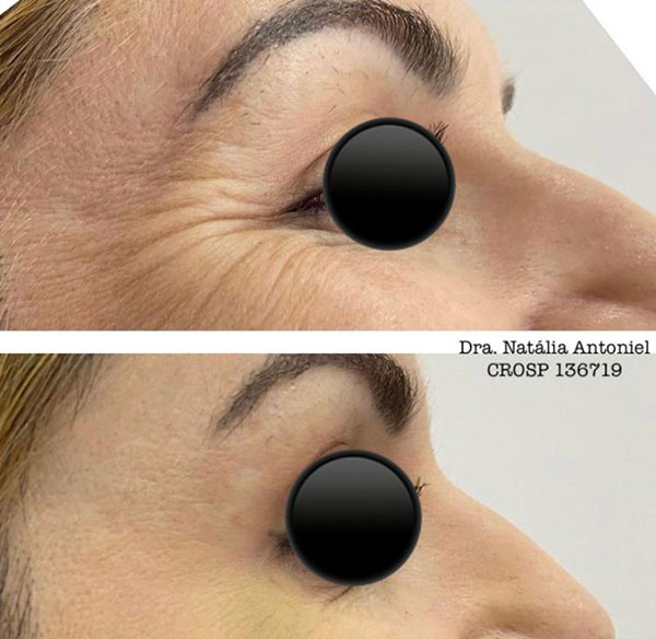 O botox também colabora em tratamentos como bruxismo, apertamento, dores de ATM, dores de cabeça O botox também colabora em tratamentos como bruxismo, apertamento, dores de ATM, dores de cabeça