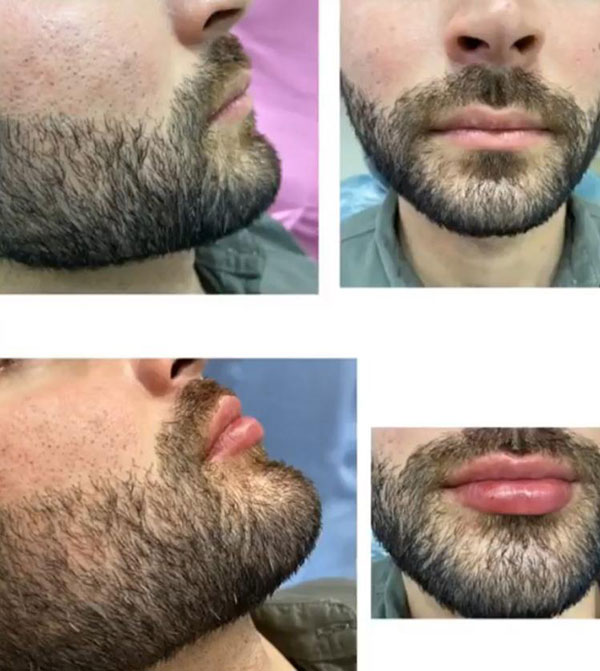 Lábios masculinos, resultado imediato e satisfatório Lábios masculinos, resultado imediato e satisfatório