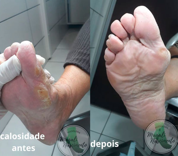 Divulgação - Calosidade antes e depois - Foto: Magali Nascimento Divulgação - Calosidade antes e depois - Foto: Magali Nascimento