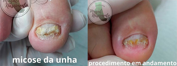 Divulgação - Micose antes e durante o tratamento - Foto: Magali Nascimento