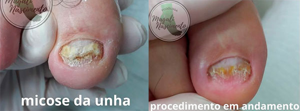 Divulgação - Micose antes e durante o tratamento - Foto: Magali Nascimento Divulgação - Micose antes e durante o tratamento - Foto: Magali Nascimento