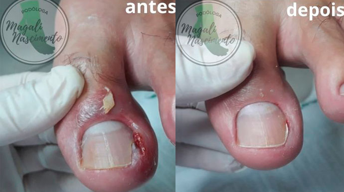 Divulgação - Unha encravada antes e depois - Foto: Magali Nascimento Divulgação - Unha encravada antes e depois - Foto: Magali Nascimento