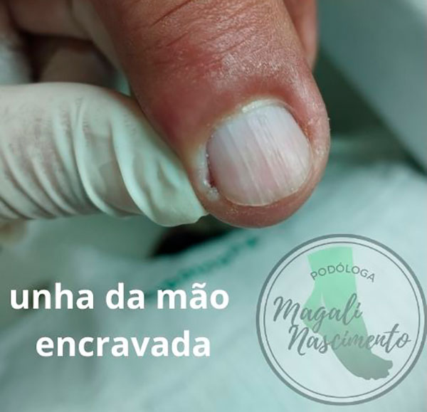 Divulgação - Unha da mão encravada - Foto: Magali Nascimento Divulgação - Unha da mão encravada - Foto: Magali Nascimento