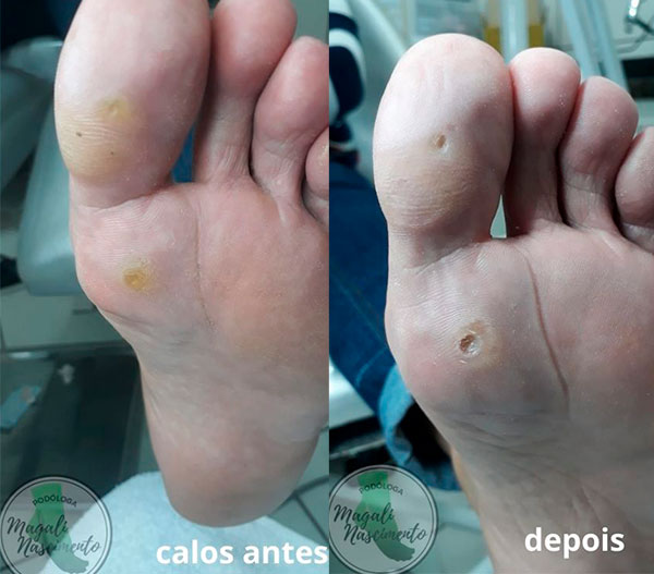 Divulgação - Calos antes e depois - Foto: Magali Nascimento Divulgação - Calos antes e depois - Foto: Magali Nascimento