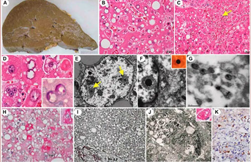 Divulgação - Patologia da infecção grave pelo SABV. Imagens mostram fígado danificado e detalhes do vírus - Foto: Assessoria de Comunicação da FMUSP