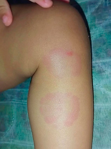 Divulgação - Hematomas na perna de Maitê Moreira - Foto: Divulgação/Arquivo Pessoal