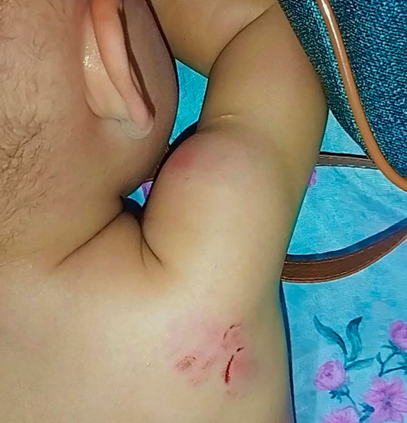 Divulgação - Hematomas nas costas e ombro de Maitê - Foto: Divulgação/Arquivo Pessoal Divulgação - Hematomas nas costas e ombro de Maitê - Foto: Divulgação/Arquivo Pessoal