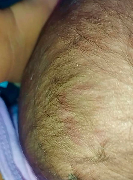 Divulgação - Hematomas na cabeça de Maitê - Foto: Divulgação/Arquivo Pessoal Divulgação - Hematomas na cabeça de Maitê - Foto: Divulgação/Arquivo Pessoal