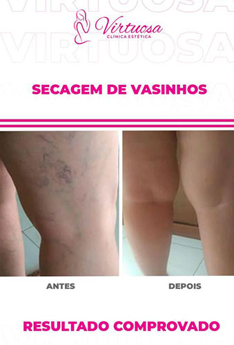 Divulgação - Antes e depois de um tratamento PEIM - Foto: Virtuosa Assis Divulgação - Antes e depois de um tratamento PEIM - Foto: Virtuosa Assis