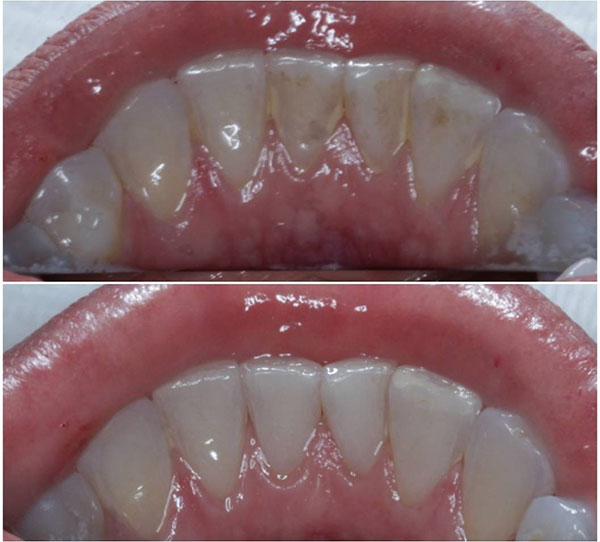 Divulgação - Antes e depois da Profilaxia - Foto: Divulgação Sartori Divulgação - Antes e depois da Profilaxia - Foto: Divulgação Sartori