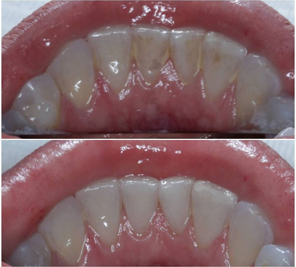 Divulgação - Antes e depois da Profilaxia - Foto: Divulgação Sartori